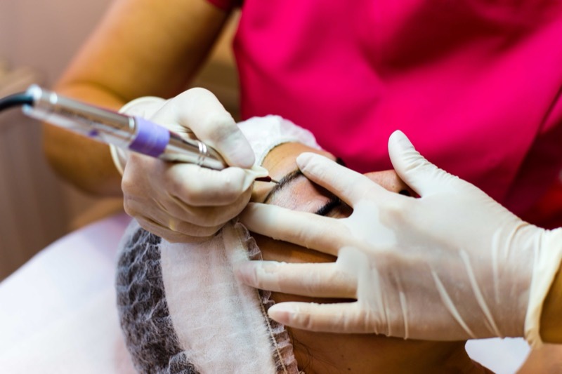 Mesotherapie mit feiner Nadel im Gesicht